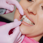 Why Veneers Are Booming, and Why Dentists Are Worried About Where People Get Them